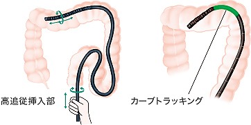 苦痛のない大腸カメラのために